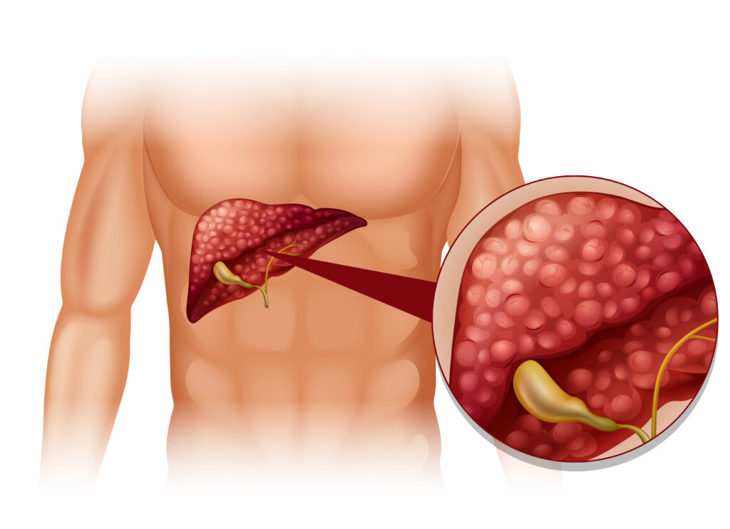 Fatty liver